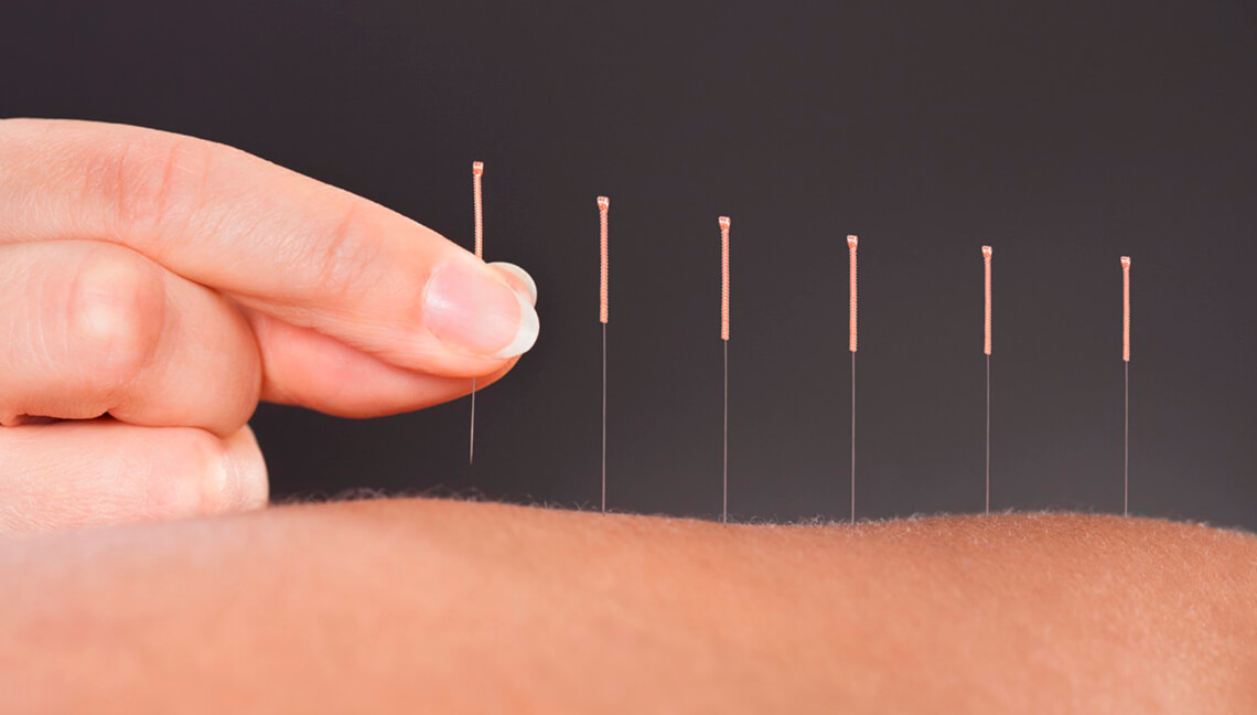 Acupuntura